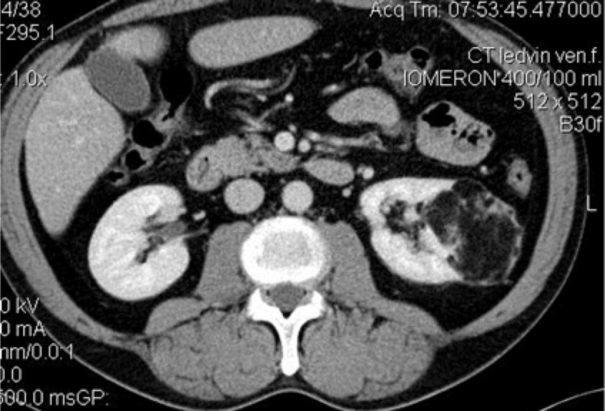 Angiomyolipom levé ledviny CT (transverzální řez)<br>
Fig 2. Angiomyolipoma of the left kidney CT (transverse section)