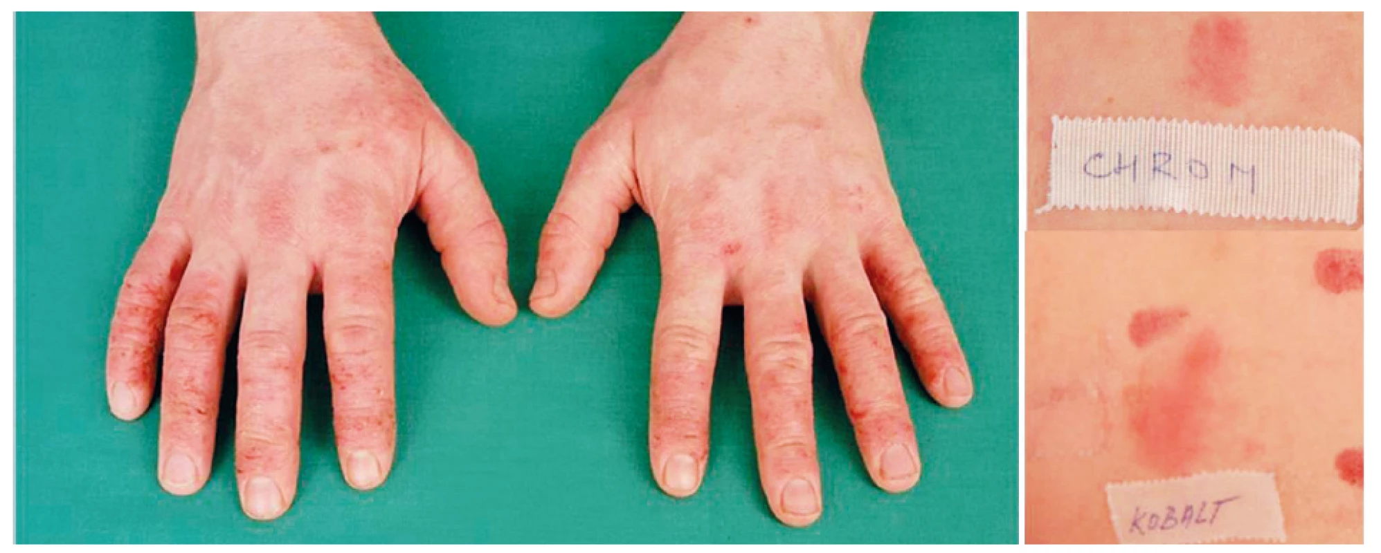 Eczema contactum prof. – atopická báze – chrom++ (cement), kobalt++, thioram mix++ (pryž) – zedník