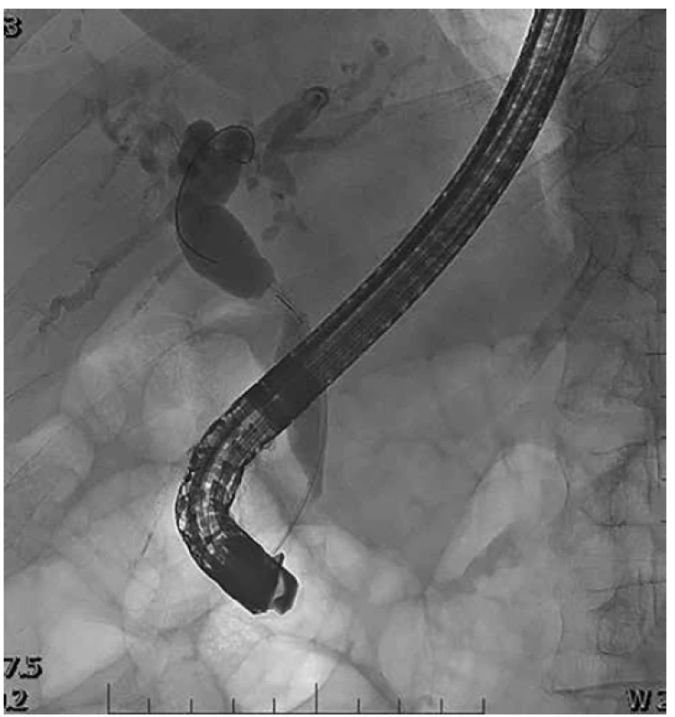 ERCP<br>
Fig. 1. ERCP