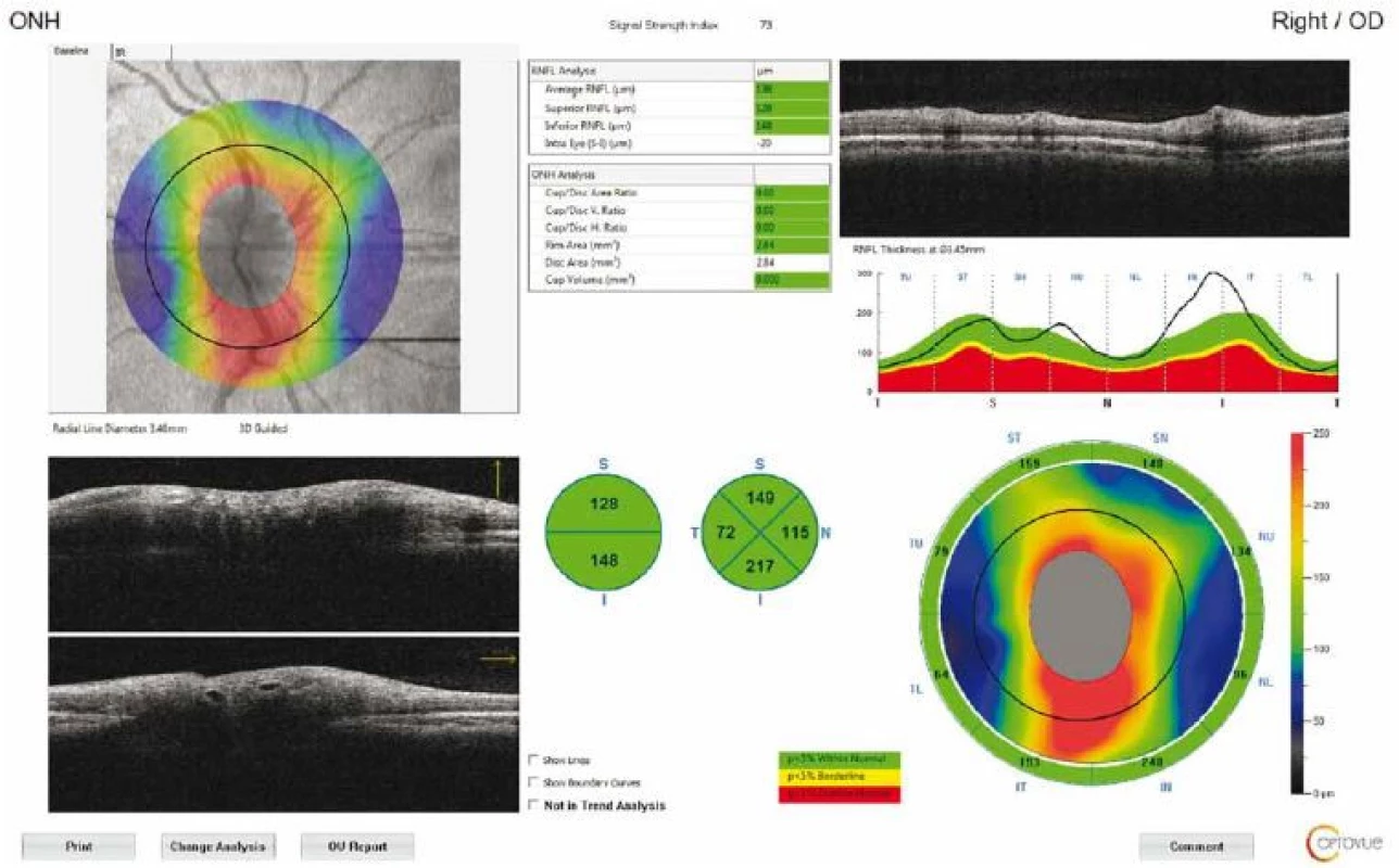 Optical coherence tomography output of peripapillary retinal nerve fibre layer thickness measurement of a patient
with idiopathic intracranial hypertension. Circular scan with a 3.4-mm diameter centring optic nerve head can be seen in fundus
image.<br>
Obr. 1. Výsledek měření tloušťky peripapilární vrstvy nervových vláken sítnice pomocí optické koherentní tomografie u pacienta
s idiopatickou intrakraniální hypertenzí. Na snímku očního pozadí je vidět kruhový sken o průměru 3,4 mm se středem v terči zrakového
nervu.