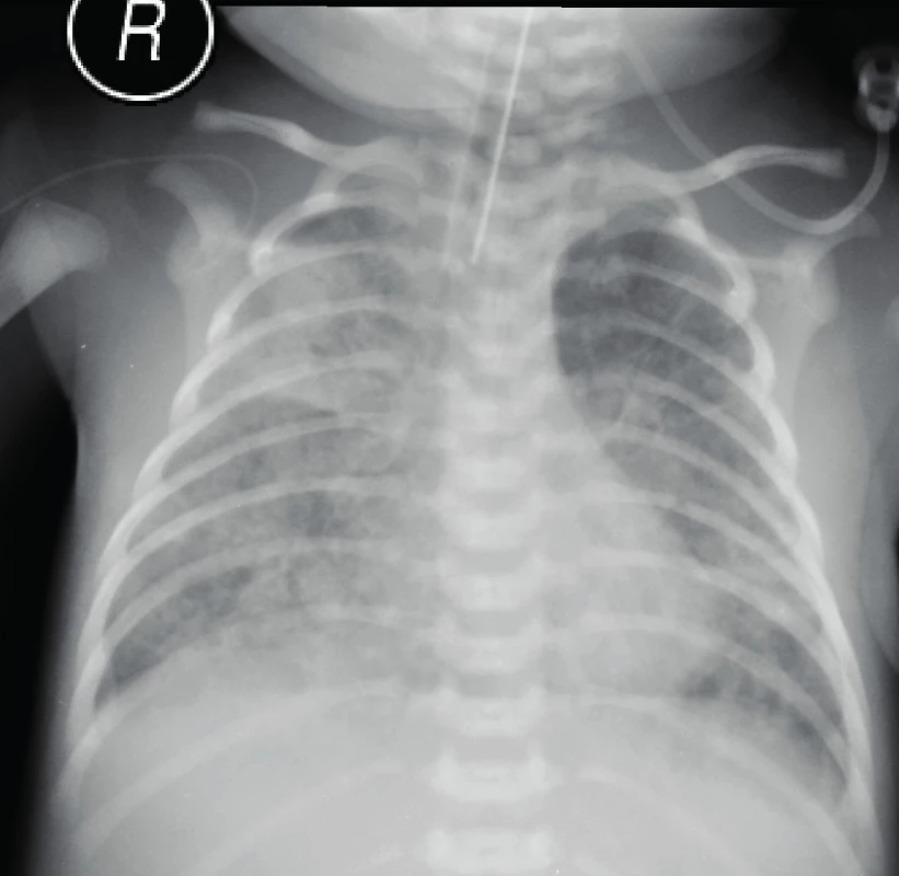 Inflammatory infiltration, neonatal pneumonia