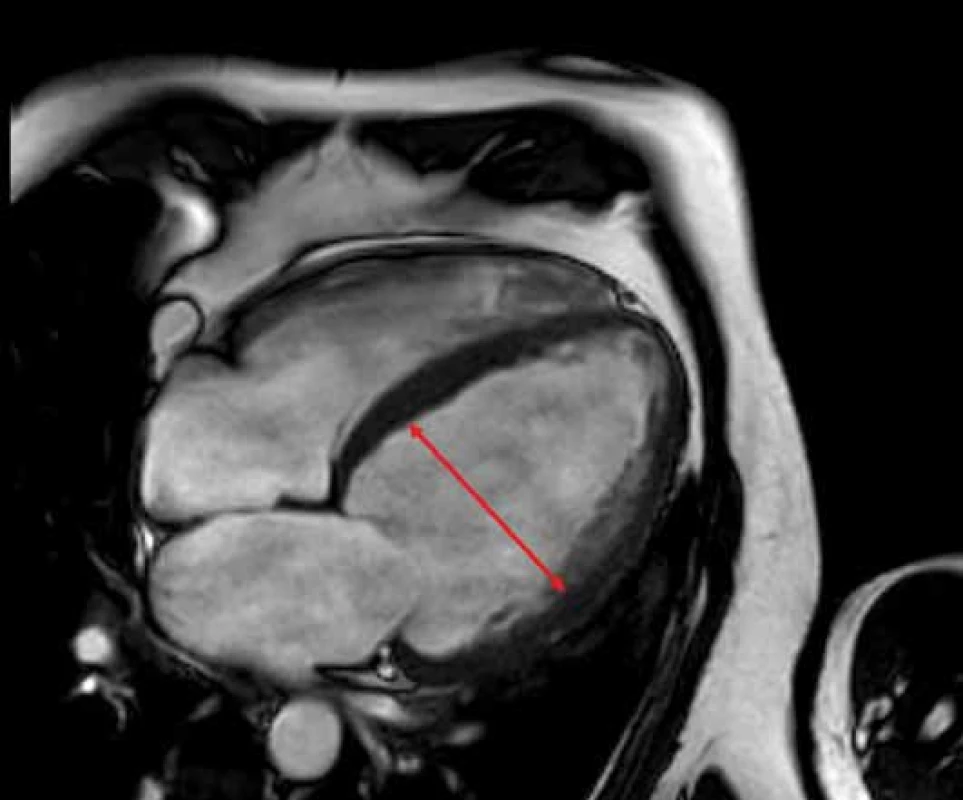 Dilatační kardiomyopatie při zobrazení na magnetické rezonanci
s dilatací levé komory srdeční s end-diastolickým rozměrem
68 mm. Zdroj: Archiv Kliniky zobrazovacích metod FN u sv.
Anny v Brně.