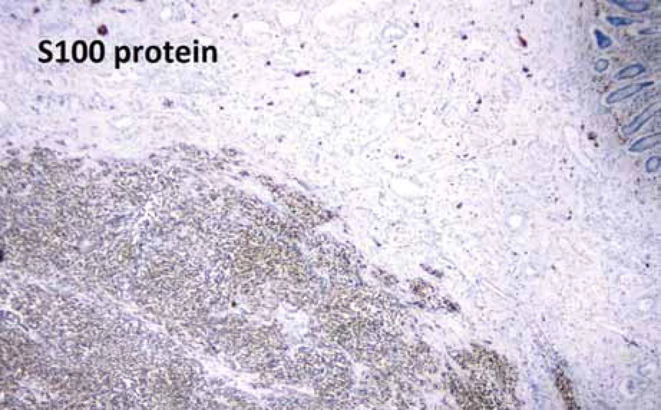 Imunohistochemie S100 proteinu.<br>
Fig. 5. Immunohistochemistry of S100 protein.