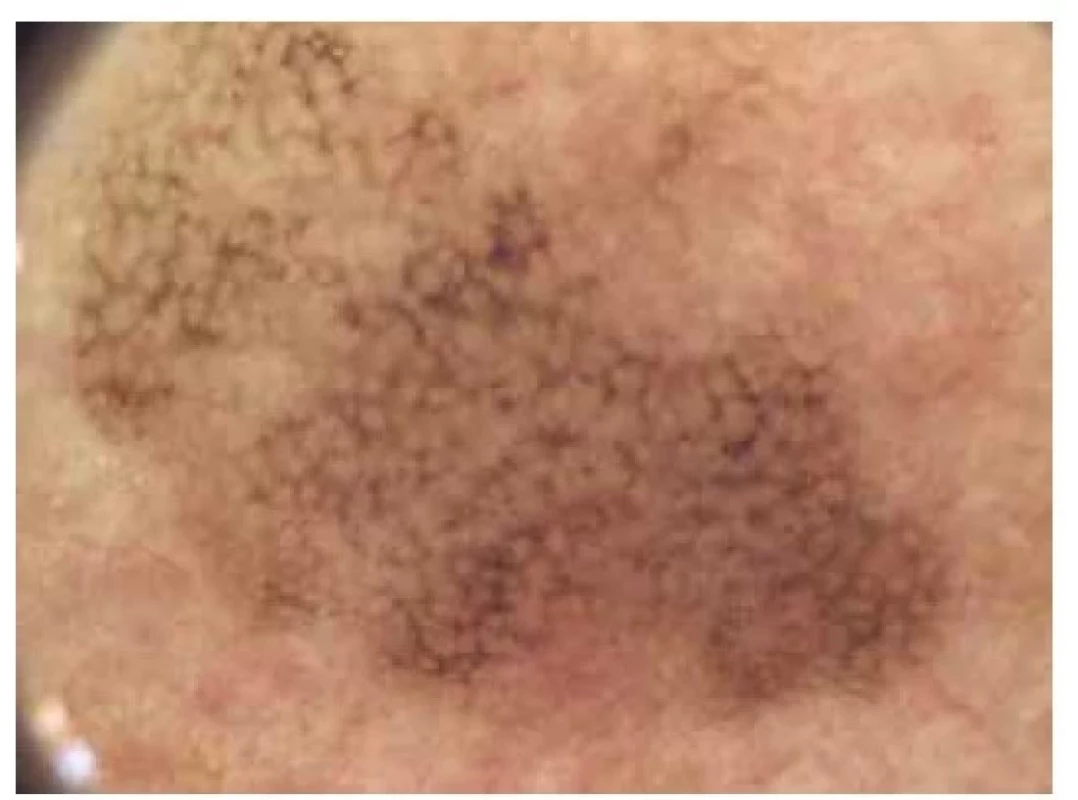 Lentigo maligna*<br>
Dermatoskopicky absence všech „nemelanomových“
dermatoskopických kritérií. Přítomnost anulárně-granulární
struktury šedé barvy, rhomboidních obrazců.