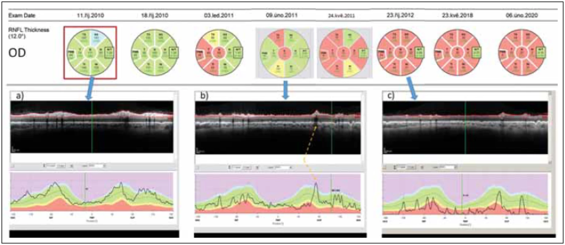 Longitudinální sledování tloušťky RNFL v peripapilární oblasti pravého oka pomocí optické koherenční tomografi e u pacientky
s AQP4-IgGpozNMOSD. V průběhu sledování proběhly dvě epizody zánětu očního nervu – na počátku října 2010 a v únoru 2011.
(a) ukazuje nález v akutní fázi zánětu.
(b) ukazuje nález po 4 měsících. Tloušťka RNFL v jednotlivých segmentech je sice ve většině segmentů v mezích normy (kódována zeleně),
avšak křivka RNFL na grafu dole je jasně oploštělá a vykazuje pokles ve všech segmentech. Na mírném zvýšení tloušťky RNFL
oproti předchozímu vyšetření se podílí edém při právě probíhající recidivě optické neuritidy ve vyšetřovaném oku. Místo, kde křivku
RNFL zvedá céva probíhající na povrchu sítnice, je označeno žlutou šipkou.
(c) ukazuje stav sítnice rok po počátku prvního zánětu. RNFL je natolik ztenčeno, že je na několika místech prakticky neměřitelné.<br>
Fig. 2. Longitudinal follow up of peripapillary RNFL thickness (right eye) in a patient with AQP4-IgGposNMOSD. Two episodes of optic
neuritis occurred during the follow-up – in October 2010 and in February 2011.
(a) shows fi nding in the acute phase of optic neuritis.
(b) shows fi ndings 4 months later. The thickness of RNFL still falls within normal values in most peripapillary segments (coded in
green) however, the curve of RNFL thickness has been fl attened and shows a loss of RNFL in all segments. A slight increase in RNFL
thickness on this day in comparison with the prior exam is caused by edema caused by the second optic neuritis in the right eye. The
blood vessels artifi cially increase the RNFL thickness (marked by a yellow arrow).
(c) shows retinal fi ndings a full year after the onset of fi rst optic neuritis in the eye. RNFL has been thinned and cannot be reliably
quantifi ed.
