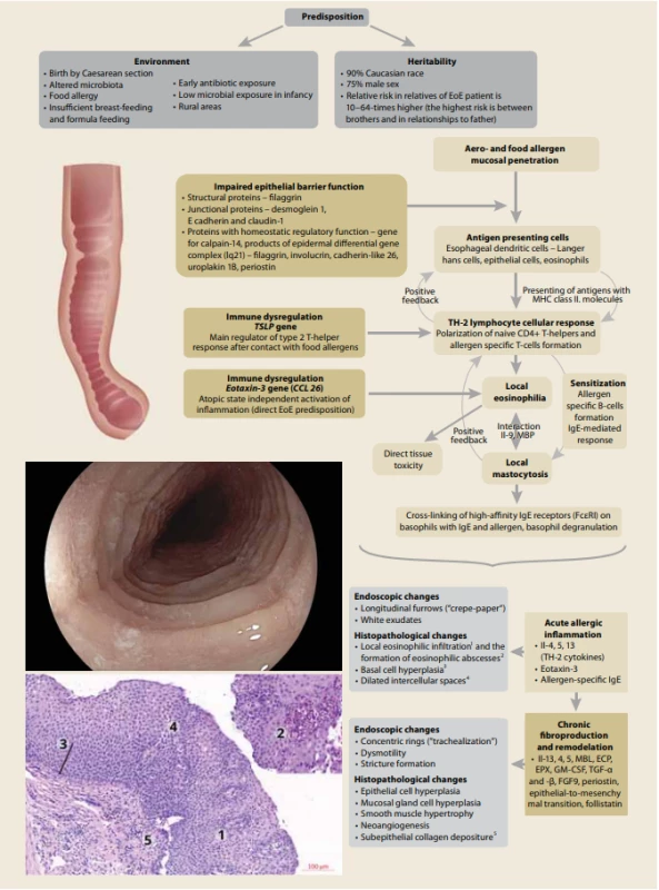 Pathophysiology of EoE.
Environment, and especially during early childhood, has the dominant impact on the multifactorial development of EoE.
The relevant factors are listed in the scheme above. Hereditary factors are generally considered to have a minor effect [4,5].
Nevertheless, genetic predispositions for EoE include mutations in the calpain-14ͺ gene and down-regulation of some additional
genes whose products are involved in epithelial barrier function (desmoglein-1, filaggrin, involucrin, and others) against allergens
from an external environment, and that barrier’s disruption is one route for sensitization [6] Whole exome sequencing has
identifi ed numerous variants of the TSLP (thymic stromal lymphopoietin) gene, which is currently considered to be a major
regulator of the TH-2 cellular response in terms of allergenic polarization after contact with allergens [7]. Moreover, the genetic
predisposition is associated also with genes for eotaxin-3 in esophageal epithelial cells, which is probably a major atopyindependent genetic factor for EoE development [8]. After an allergen’s penetration of the esophageal mucosa, antigen-presenting cells present the processed antigens to T helpers type 2. Activation of the so-called TH-2 response is accompanied by
release of numerous cytokines, of which interleukin-13 (IL), IL-4, and IL-5 are considered to be most important in development
of the acute infl ammatory phase of EoE, which results in increased eotaxin 3 expression followed by local eosinophilic
hyperfiltration. Esophageal tissue damage leads to additional disruptions of the superficial epithelium followed by lingering
release of proinfl ammatory chemokines by activated eosinophils maintaining chronic infl ammatory infiltration and fibrous
tissue production that results in irreversible esophageal strictures formation [9].
CCL 26 – chemokine (C-C motif) ligand ͸ͼ, ECP – eosinophil cationic protein, EPX – eosinophil peroxidase, FGFͿ – fi broblast
growth factor Ϳ, IL – interleukin, MBP – major basic protein, TGF-α and β – transforming growth factor α and β, TH-2 – T helper
type 2, TSLP – thymic stromal lymphopoietin.
Figure 4ͺ was prepared in accordance with Davis et al [Ϳ] and created in collaboration with the Service Center for E-Learning
at Masaryk University, Faculty of Informatics (part of user support at IS MU, Faculty of Informatics, Masaryk University, Brno).<br>
Obr. 4. Patofyziologie EoE.
Environmentální vlivy, zejména pak v raném dětství, mají dominantní dopad na multifaktoriální vývoj EoE. Relevantní faktory jsou
uvedeny v předkládaném schématu. Obecně se má za to, že dědičné faktory mají pouze malý vliv [4,5]. Mezi genetické predispozice
pro EoE však patří mutace genu calpain-14 a down-regulace některých dalších genů, jejichž produkty se podílejí na funkci epiteliální
bariéry (desmoglein-1, filaggrin, involucrin a další) proti alergenům z vnějšího prostředí a narušení této bariéry je jednou z cest
senzibilizace [6.] Metodou celoexomového sekvenování byla identifi kována řada variant genu TSLP (thymic stromal lymphopoietin),
který je v současné době považován za hlavní regulátor buněčné odpovědi TH-2 z hlediska alergenní polarizace po kontaktu
s alergeny [7]. Genetická predispozice je navíc spojena také s geny pro eotaxin-3 v epiteliálních buňkách jícnu, což je pravděpodobně
hlavní genetický faktor nezávislý na atopii pro vývoj EoE [8]. Po průniku alergenu do sliznice jícnu antigen prezentující buňky
předkládají zpracované antigeny pomocným T lymfocytům typu 2. Aktivace takzvané TH-2 odpovědi je doprovázena uvolňováním
mnoha cytokinů, z nichž jsou interleukin-13 (IL), IL-4 a IL-5 považovány za nejdůležitější ve vývoji akutní zánětlivé fáze EoE, která vede
ke zvýšené expresi eotaxinu-3 následované lokální eozinofilní infiltrací. Poškození tkáně jícnu vede k dalšímu narušení povrchového
epitelu, po kterém následuje přetrvávající uvolňování prozánětlivých chemokinů aktivovanými eozinofily, kdy dochází k chronické
zánětlivé infiltraci a fibrotizaci tkáně, což vede k tvorbě ireverzibilních striktur jícnu [9].
CCL 26 – chemokinový ligand 26 (C-C motiv), ECP – eozinofilní kationický protein, EPX – eozinofilní peroxidáza, FGF9 – fibroblastový
růstový faktor 9, IL – interleukin, MBP – hlavní bazický protein, TGF-α a β – transformující růstový faktor α a β, TH-2 – pomocný
T lymfocyt typu 2, TSLP – thymický stromální lymfopoetin.
Obr. 4 byl převzat a upraven dle Davis et al [9] a vytvořen ve spolupráci se Střediskem služeb pro e-learning Masarykovy univerzity
(součást uživatelské podpory na IS MU, Fakulta informatiky Masarykovy univerzity, Brno).