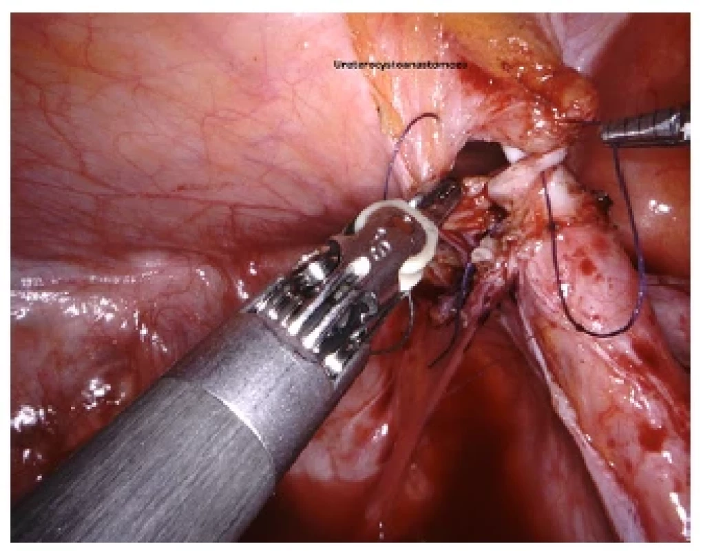 Sutura ureteru a močového měchýře – ureterocystoanastomóza <br> 
Fig. 5. Suture of ureter and bladder – ureterocystoanastomosis