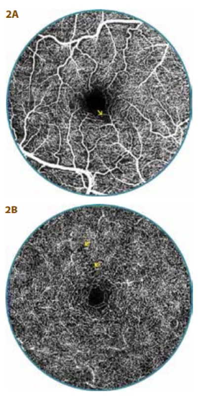  OCT-A examination of 20 year old
diabetic patient (13 year duration of diabetes) with diabetic preretinopathy (DpR)<br>
A. Superficial vascular complex with irregularity of parafoveal capillaries with zones of non-perfusion (arrow)<br>
B. The capillary network is more or less
regular in the deep vascular complex, but
in place the finding is distinguished by
thinning (arrow), surface of foveal avascular zone is narrower – 0.16 mm2