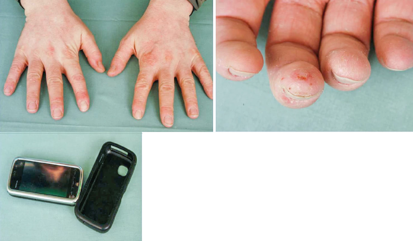Eczema contactum et atopicum – IPPD+++ (obal mobilního telefonu), disperzní
oranž 3++, disperzní oranž 1++, lyral+-++ (kosmetické přípravky) – hodinář