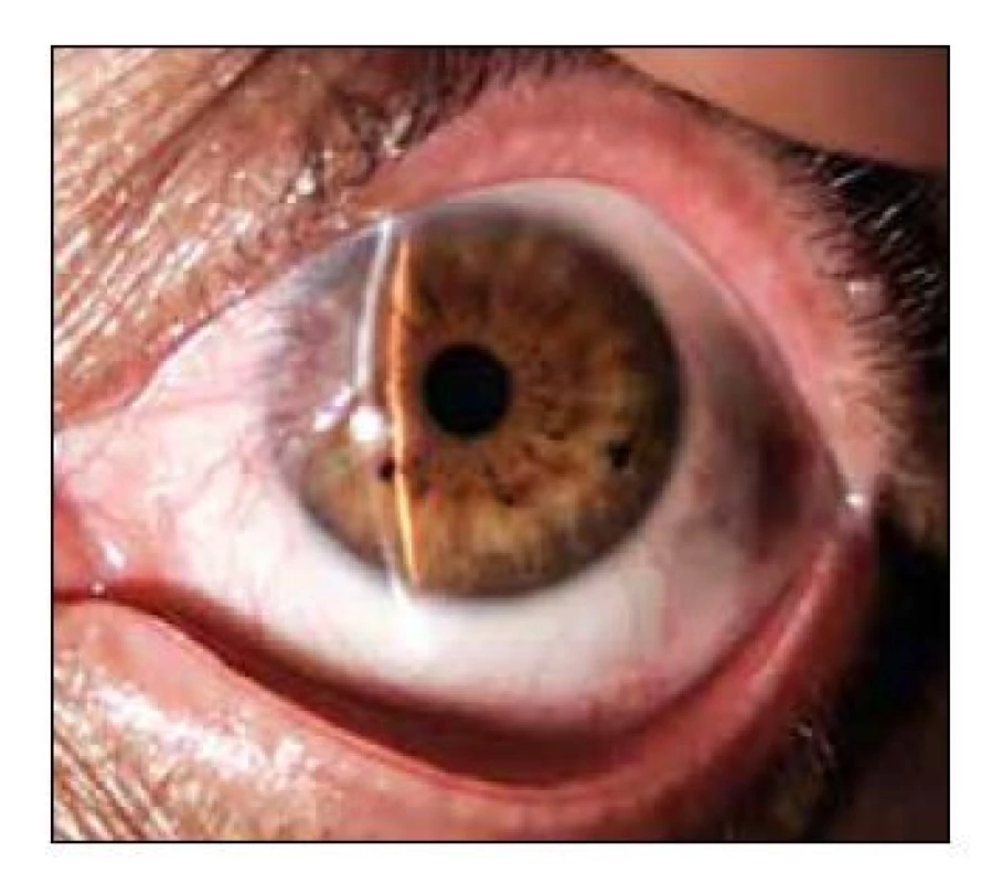 Pterygium. [Foto: archiv autorky]