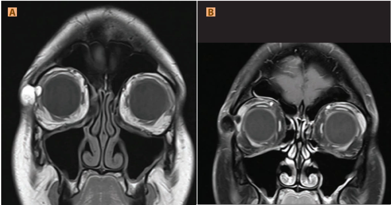 Dermoidní cysta: (A) ohraničená septovaná formace vycházející z frontozygomatické sutury, větší porce subkutánně, menší zasahuje intraorbitálně, hypersignální v T1WI, (B) hyposignální T1FS (obsah bohatý na lipidy)