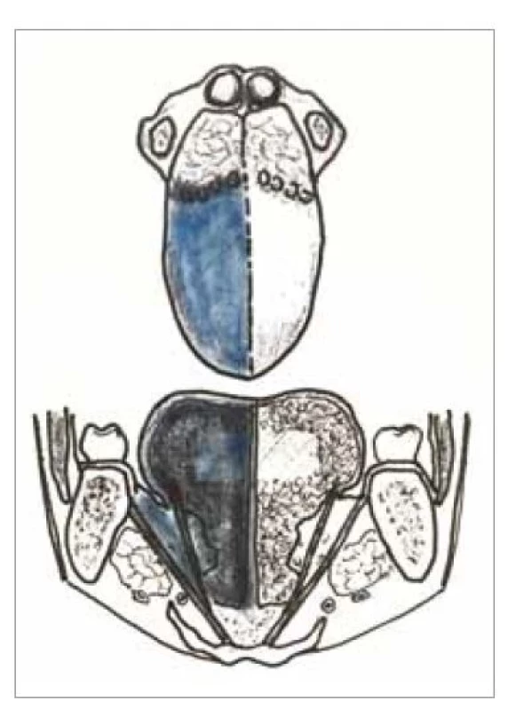 Schéma kompartmentovej hemiglosektómie
– glosektómia typ IIIB
(upravené podľa Ansarin et al. [6]).<br>
Fig. 1. Drawing of the compartmental
hemiglossectomy – glossectomy
type IIIB (adjusted according to Ansarin
et al. [6]).