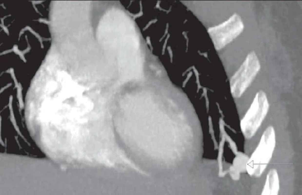 Arteriovenózní malformace na plicích u pacientky s hereditární hemoragickou teleangiektázií před odstraněním malformace pomocí endovaskulárního výkonu.