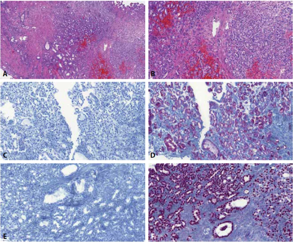 Transuretrální resekce prostaty s nefrogenním adenomem. Přítomny jsou tubulární struktury (A, B), které v kontextu nálezu v prostatě mohou být snadno zaměněny za prostatický adenokarcinom. Imunohistochemický profil stran „markerů prostatického adenokarcinomu“ -34bE12/K-903 (C) a PIN koktejl (tedy kombinace p63 a racemázy/AMACR) (D) pak prostatický adenokarcinom dost věrně napodobuje. Pro správnou diagnózu je tak nejdůležitější znalost této léze, diagnózu lze imunohistochemicky potvrdit nejlépe imunohistochemickým průkazem PAX8 (F) či např. prostatickým markerem NKX3.1, který je negativní (E).