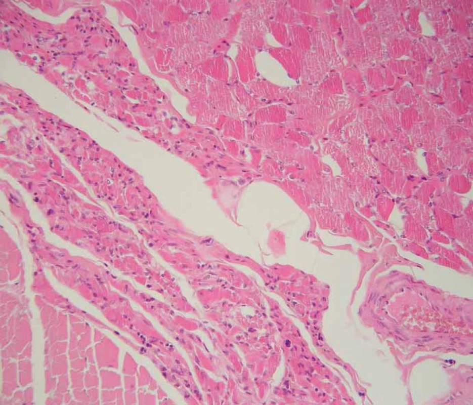 Obraz chronické denervační neurogenní atrofi e (šipka) v příčně pruhované svalovině
bránice. Standardní barvení hematoxylin-eozinem, původní zvětšení 200×.<br>
Fig. 2. Chronic neurogenic atrophy (arrow) of skeletal muscle of the diaphragm. Standard
hematoxylin and eosin staining, original magnification 200×.