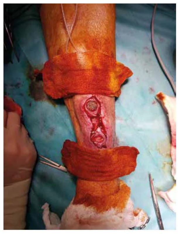 Excize defektů AVF<br>
Fig. 3: AVF – excision of the defects