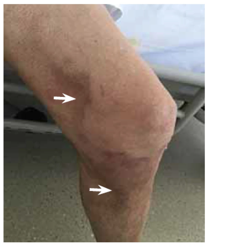 Histologické vyšetření kožních
infiltrátů na dolní končetině (šipky)
zjistilo pouze nespecifické změny (nevýrazná
perivaskulární dermatitida).<br>
Fig. 5. Histology of skin infiltrates on
the lower extremity (arrows) revealed
non-specific changes only (mild perivascular
dermatitis).