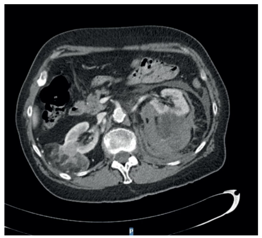 Ruptura angiomyolipomu vlevo na CT břicha<br>
Fig. 2: Rupture of the left-sided angiomyolipoma on abdominal
CT