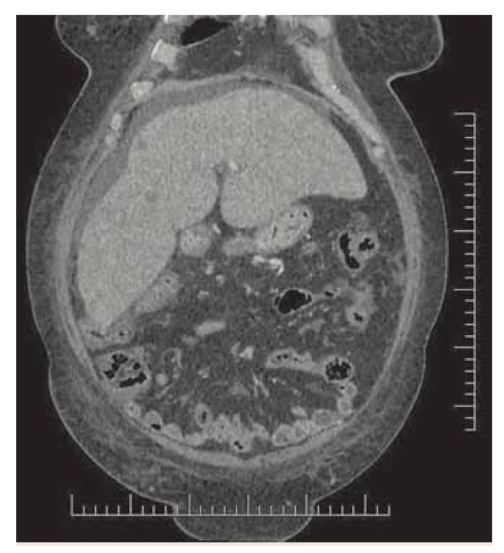 CT - koronálna multiplanárna
rekonštrukcia, venózna fáza, hypodenzné
ložiská v pravom laloku,
ascites.<br>
Fig. 3. CT – coronary multiplanar reconstruction,
venous phase, hypodense lesions
in the right lobe, ascites.