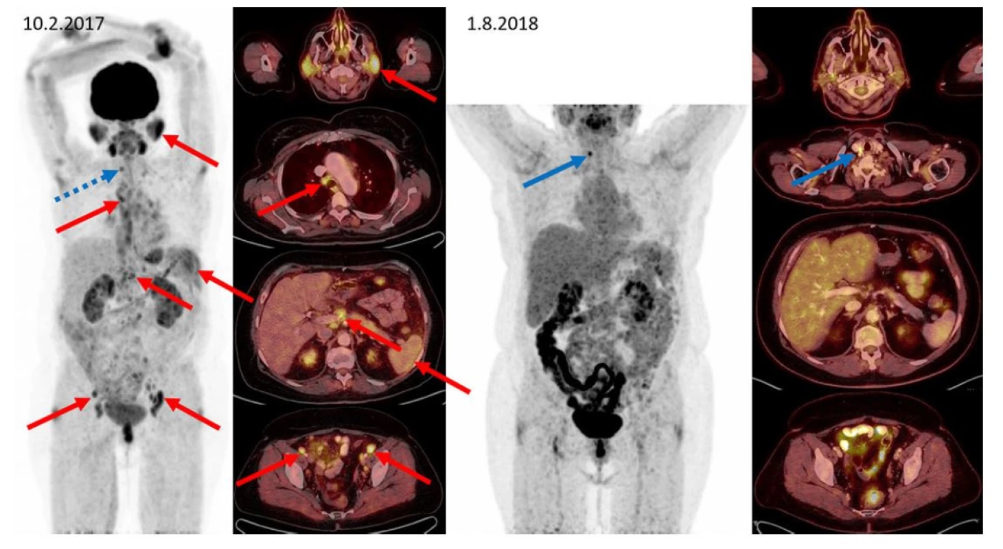 F–FD6 PET/CT vyšetření u pacientky s IgG4- RD a generalizovaným postižením. Červenými šipkami jsou označeny metabolicky aktivní infiltrace
příušních slinných žláz, zvětšená aktivní uzlina paratracheální vpravo, metabolicky aktivní slezina, uzliny periportálně a uzliny podél zevních ilických
cév oboustranně. Další nálezy: infiltrace v gll. submandibularis oboustranně, v dalších uzlinách mediastina, břicha i retroperitonea a presakrálně jsou
patrny na MIP zobrazení, ale nejsou označeny. Všechna tato metabolicky aktivní ložiska při kontrolním vyšetření po léčbě rituximabem, cyklofosfamidem
a dexametazonem zanikají. Jen v pravém laloku štítnice (označeno modře) se zvyšuje aktivita a při přešetření štítnice byl později prokázán papilokarcinom