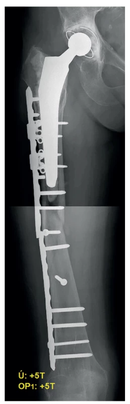 Selhání osteosyntézy 5 týdnů od operace<br>
Fig. 3: Implant failure 5 weeks after surgery