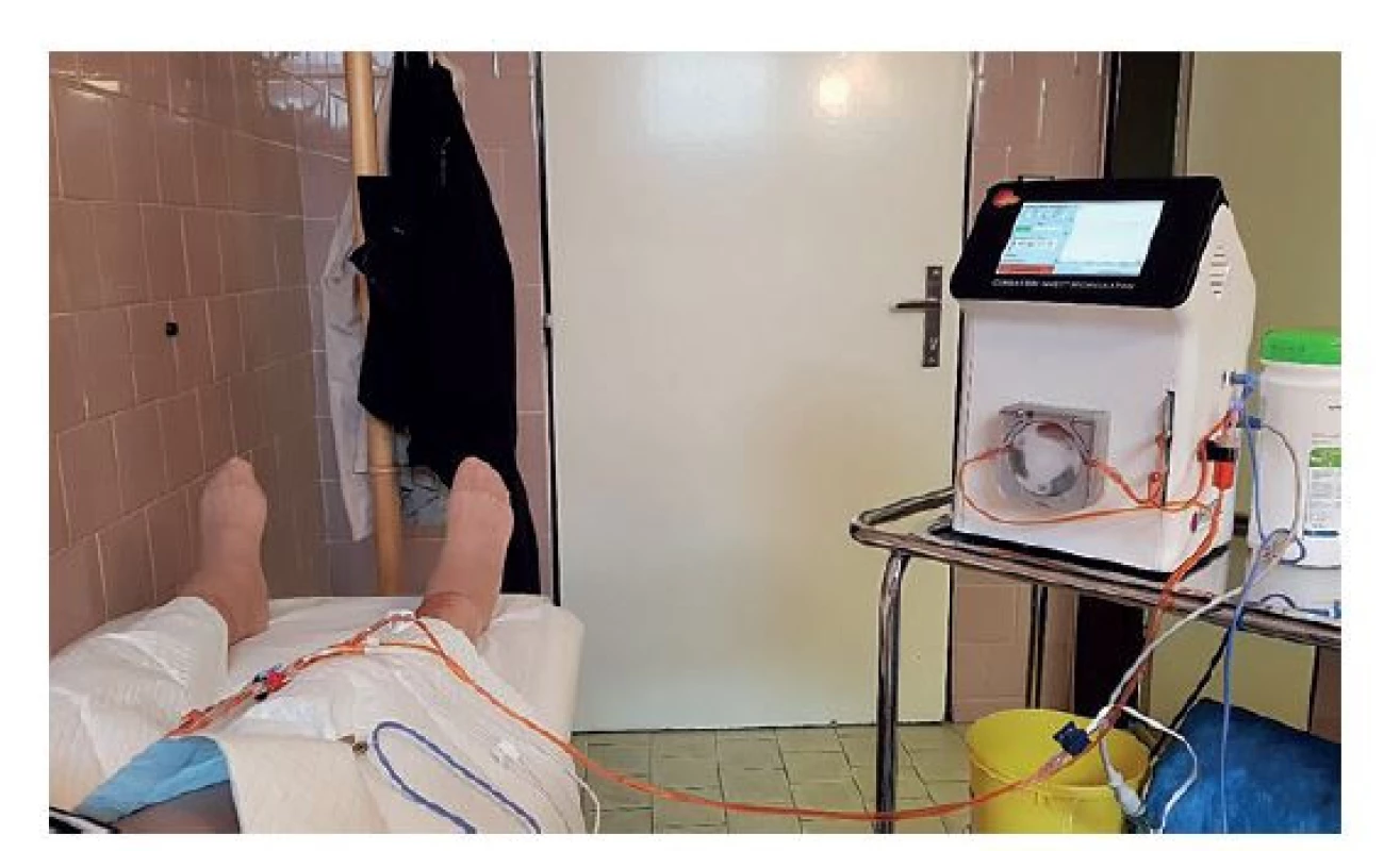 Systém Combat BRS V5 s napojeným jednorázovým
setem<br>
Cytostatikum je ohříváno přístrojem a pumpou vháněno do
močového měchýře.<br>
(Foto archiv autora)<br>
Fig. 2: Combat BRS V5 system in use<br>
The cytostatic agent is heated and pumped through the single-
-use set into the patient’s bladder via the inserted catheter.<br>
(Photo: Author‘s archive)