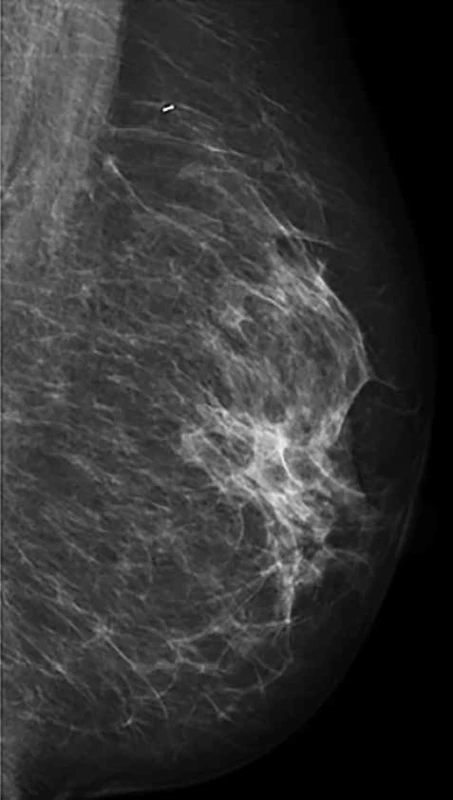 Regrese nálezu po NT (ident. klip v místě předchozího tumoru) <br>Fig. 2: Regression of tumor after NT (ident. clip in the area of the previous tumor)
