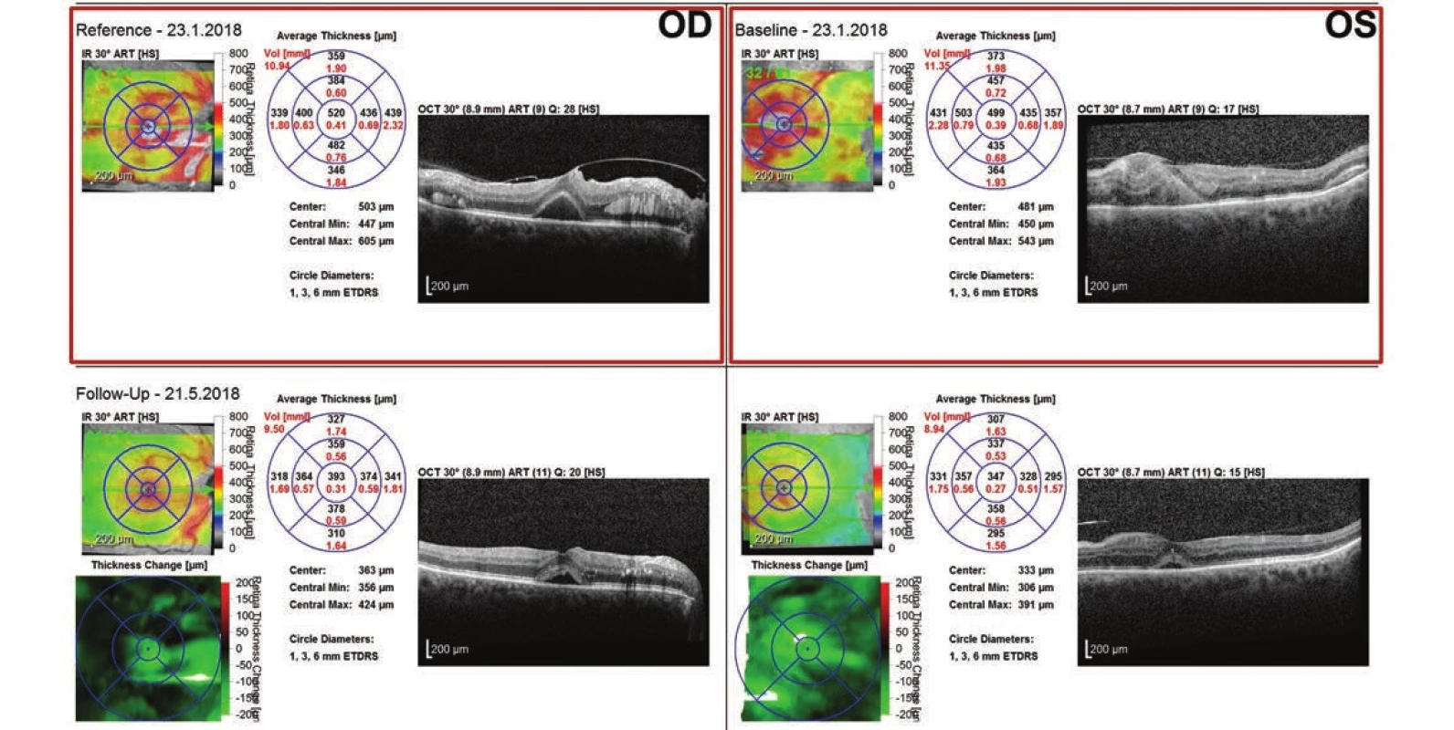 Follow-up examination image of macula of right eye: decrease of ablation of fovea, partial absorption of intraretinal deposits, in left eye individual layers of neuroretina can now be distinguished 
