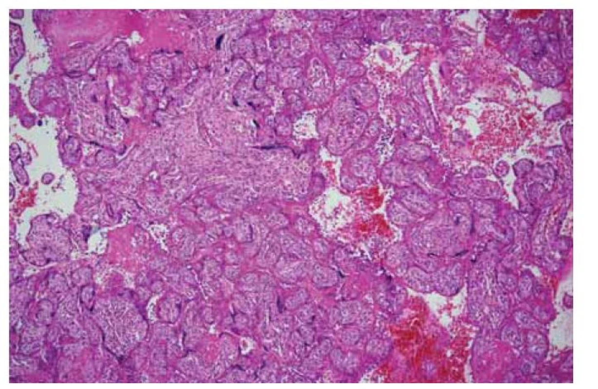 Histiocytární intervilositida s masivními depozity perivilózního fibrinoidu
(HE, 100x).<br>
Fig. 3. Histiocytic intervillositis with massive perivillous fibrinoid deposition
(HE, 100x).