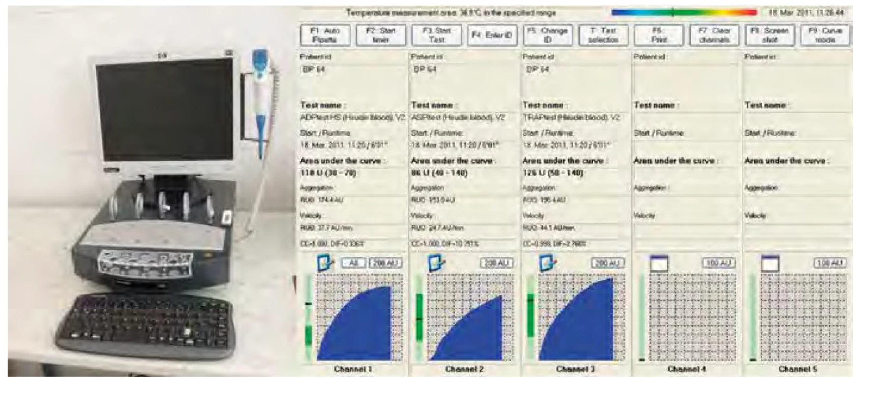 Přístroj Multiplate + výsledek standardního testu
