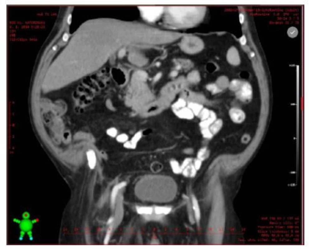CT po exstirpaci 12kilového tumoru retroperitonea<br>
Fig. 2. CT after exstirpation of 12 kilogram retroperitoneal
tumor