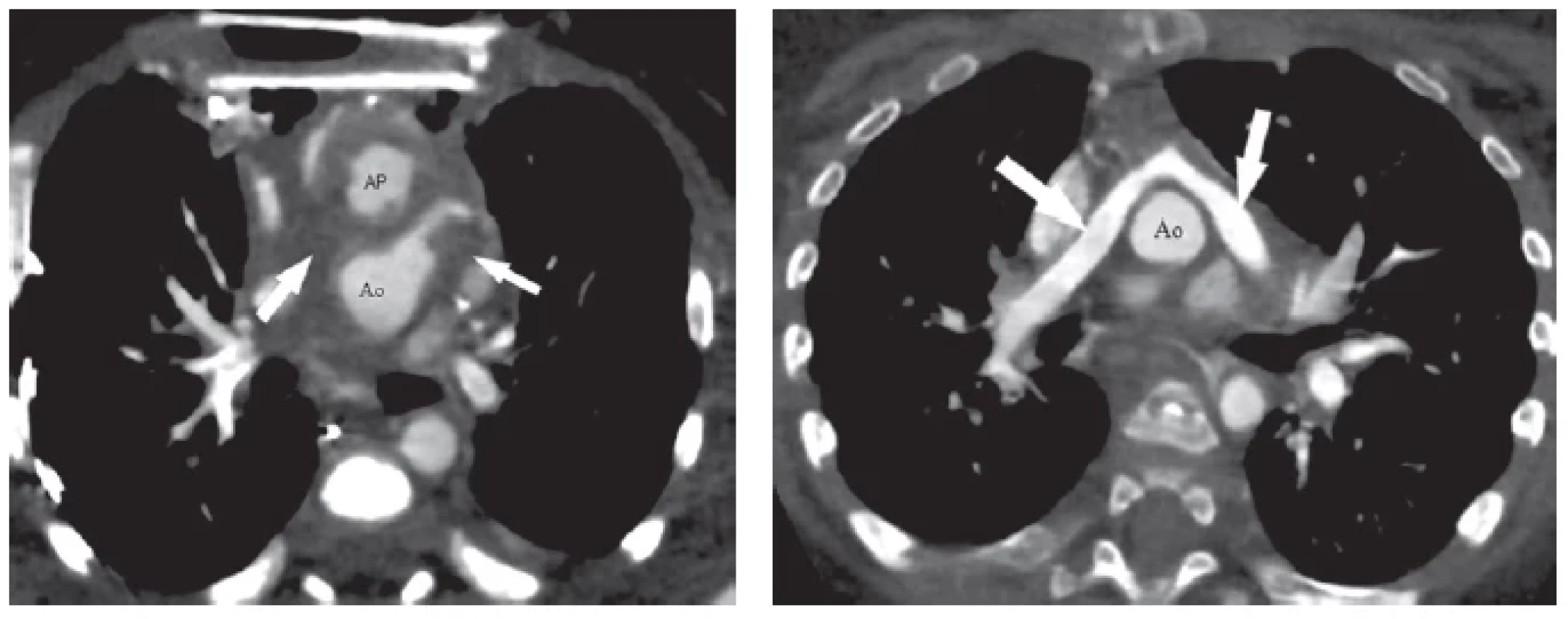 CTA u 2-týždňového pacienta s D-transpozíciou veľkých ciev po chirurgickej korekcii (arteriálny switch s LeCompte manévrom)
na ECMO (mimotelový obeh) pre závažnú hypoxémiu (pacient s otvoreným hrudníkom). CTA (obrázok vľavo) odhalilo kompletnú trombózu
oboch ramien pľúcnice (šípky ukazujú na miesta, kde by mali byť opacifikovné ramená pľúcnice). Pacient prežil iba vďaka alternatívnej
perfúzii pľúc prostredníctvom aortopulmonálnych kolaterál. Na základe CTA nálezu bola u pacienta realizovaná chirurgická trombektómia
s výborným efektom. Kontrolné CTA už po zatvorení hrudníka bez ECMO (obrázok vpravo). Šípky ukazujú na ramená pľúcnice obsadajúce
aortu po LeCompte manévri. Oba obrázky v axiálnej projekcii.