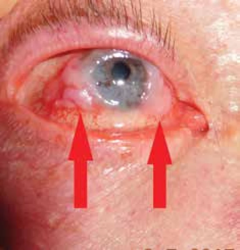 Clinical picture of a patient with squamous cell carcinoma
of bulbar conjunctiva