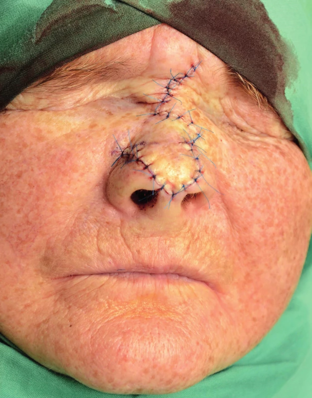 Postoperative result (Author’s archive)