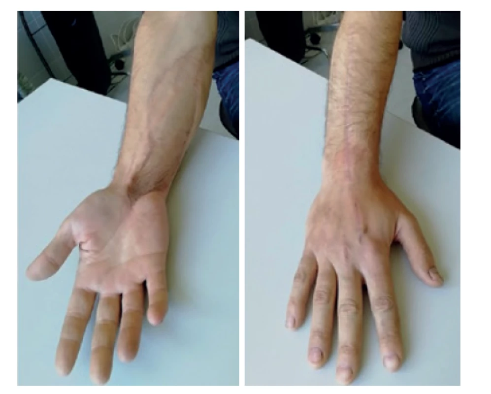 Klinický stav postižené končetiny 12 měsíců od
dermatofasciotomie<br>
Končetina je bez otoku a vzniku Volkmannovy ischemické
kontraktury.<br>
Fig. 2: Clinical findings of the affected extremity 12 months
after dermatofasciotomy<br>
The limb is free of swelling with no signs of Volkmann‘s ischemic
contracture.