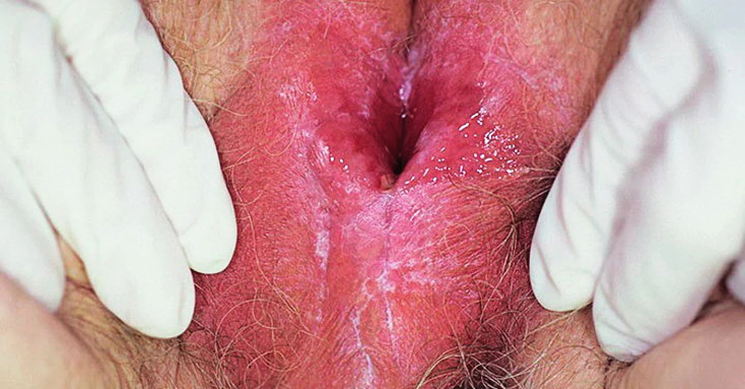 Lichen planus (foto autor) se projevuje symetrickým výsevem
výrazně svědivých plochých a lesklých polygonálních červenohnědých
papul s bělavou kresbou na povrchu (Wickhamovy strie).