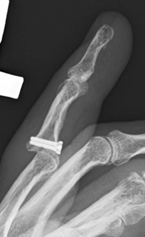 Selhání osteosyntézy