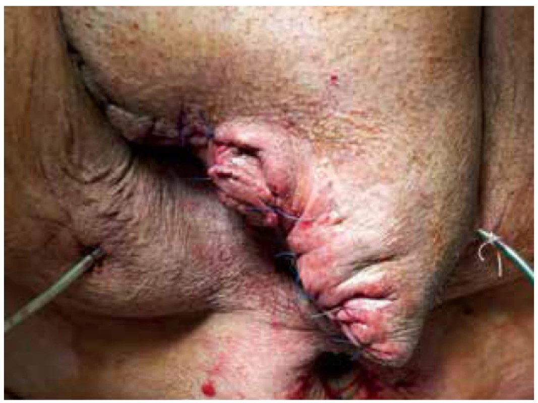 Stav po kompletní sutuře s drenáží<br>
Fig. 6. Condition after complete suture with drainage