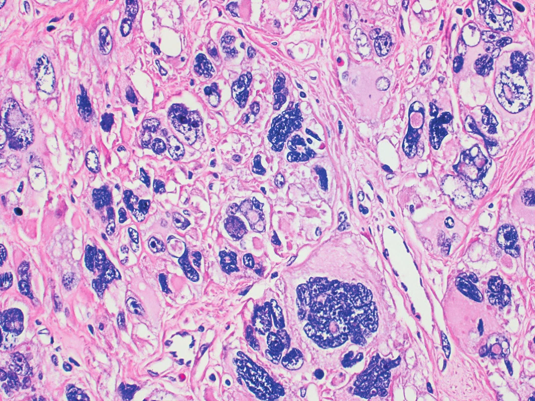 Leiomyoma with bizarre nuclei. Note pleomorphic nuclei
with coarse granular chromatin. Nuclear pseudoinclusions may be
seen (HE, 400x)