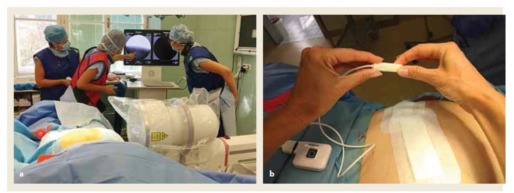 Implantace neurostimulátoru.<br>
a) implantace elektrody pod RTG kontrolou.<br>
b) připojení elektrody na stimulátor (archiv autorů).<br>
Fig. 4. Neurostimulator implantation.<br>
a) implantation of the electrode under X-ray control.<br>
b) connection of the electrode to the stimulator (authors’ archive).