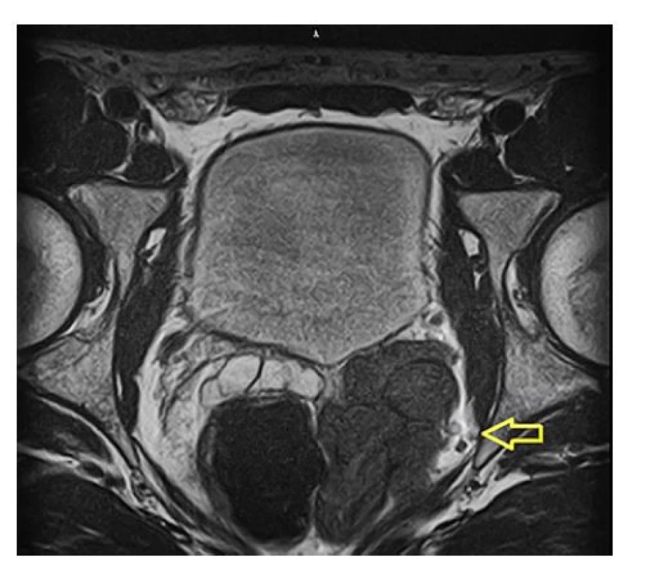 Magnetická rezonance – dilatace semenného
váčku<br>
Fig. 2. Magnetic resonance – dilatation of ejaculatory
duet