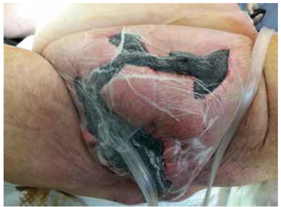 Naložení VAC do defektu<br>
Fig. 5. Vacuum Assisted Closure of the defect