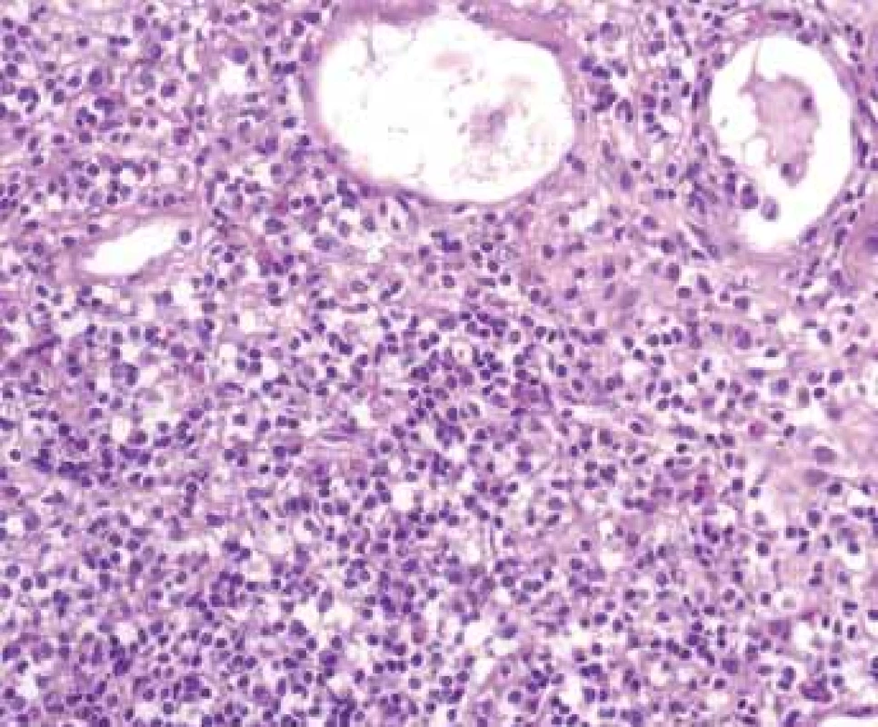 Histologické nálezy u pacientů s IBD a renálním postižením (tubulointersticiální nefritida, glomerulonefritida, AA amyloidóza).<br>
Fig. 1. Biopsy pictures in IBD patients with renal illness (tubulointerstitial nephritis, glomerulonephritis, AA amyloidosis).