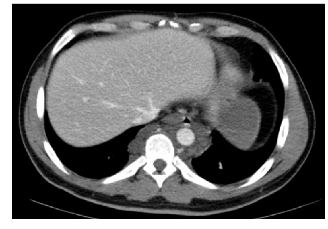 Kontrastní CT scan (axiální rovina) – patologická masa v hrudníku
prevertebrálně a paraaortálně
