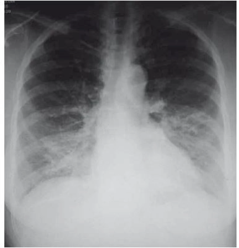 Pneumonie vpravo bazálně.<br>
Fig. 2. Right basal pneumonia.