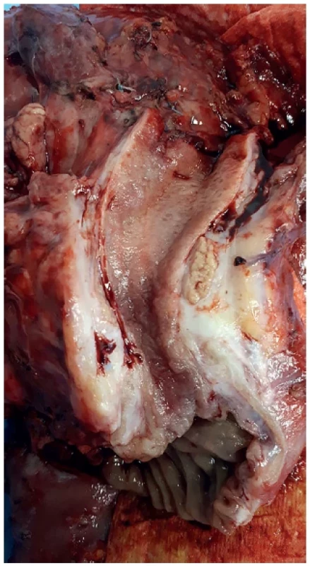 Resekát hlavy pankreatu se stenózou na podkladě
fibrózní přestavby hlavy pankreatu při toxonutritivní formě
chronické pankreatitidy <br> 
Fig. 1. Specimen of resected pancreatic head with bile
duct stenosis due to fibrosis in the toxo-nutritive form of
chronic pancreatitis