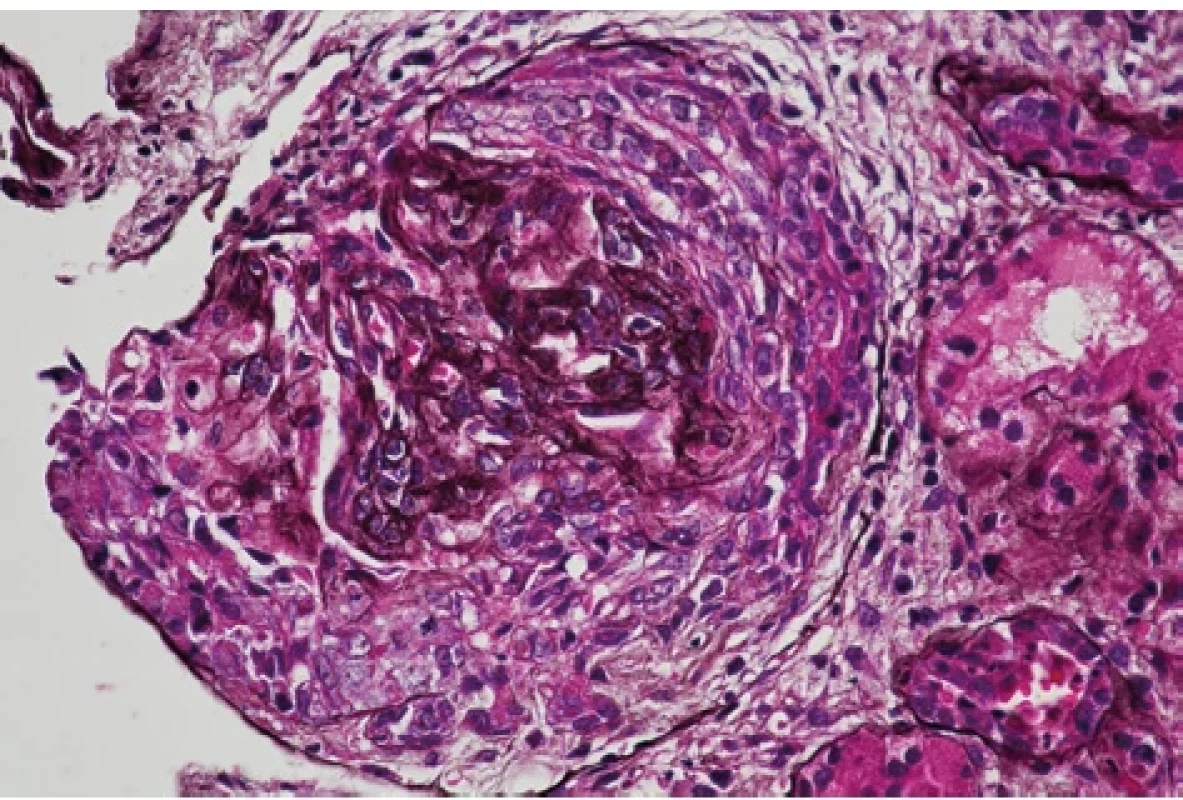 Kolabovaný glomerulární kapilární trs pod celulárním srpkem (stříbření, zvětšení 400×), archiv autorů