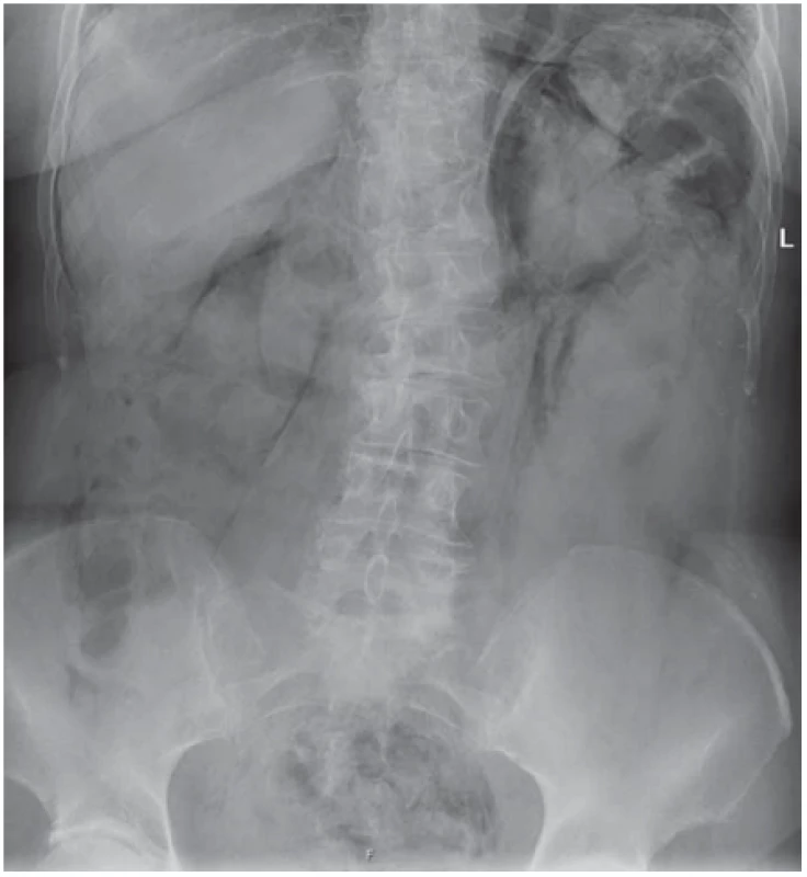 Prostý snímek břicha vleže – masivní pneumoperitoneum po koloskopii.<br>
Fig. 2. Plain X-ray of the abdomen, prone – with a massive pneumoperitoneum
after colonoscopy.
