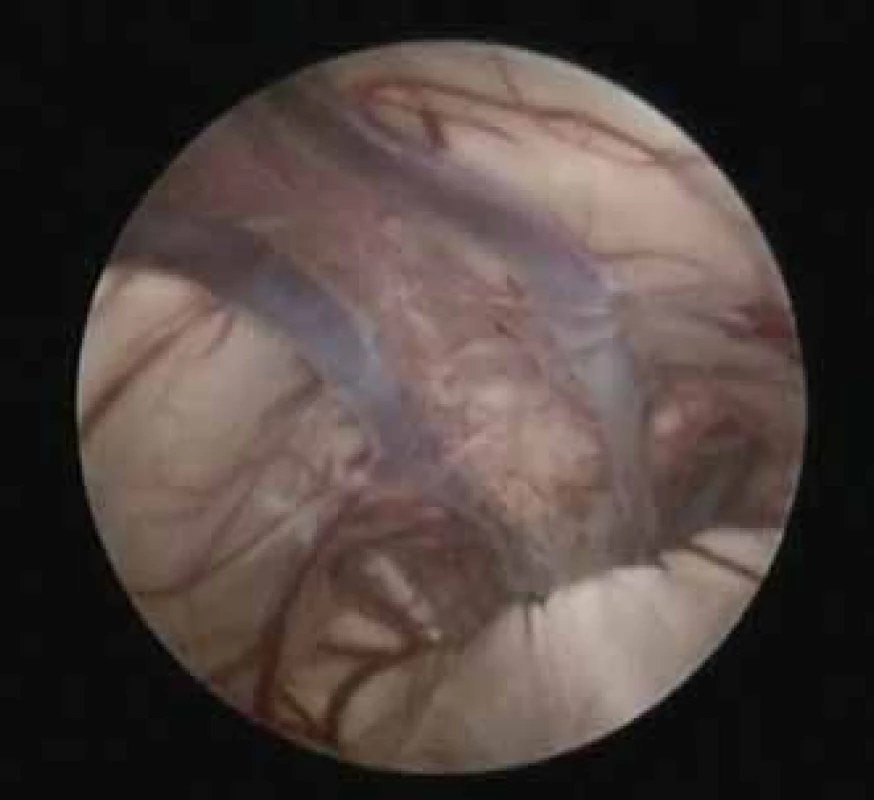 Vnitřní mozkové žíly uvnitř cysty
cavum veli interpositi (endoskopický
pohled).<br>
Fig. 3. Internal cerebral veins inside the
cyst of the cavum veli interpositi (endoscopic
view).