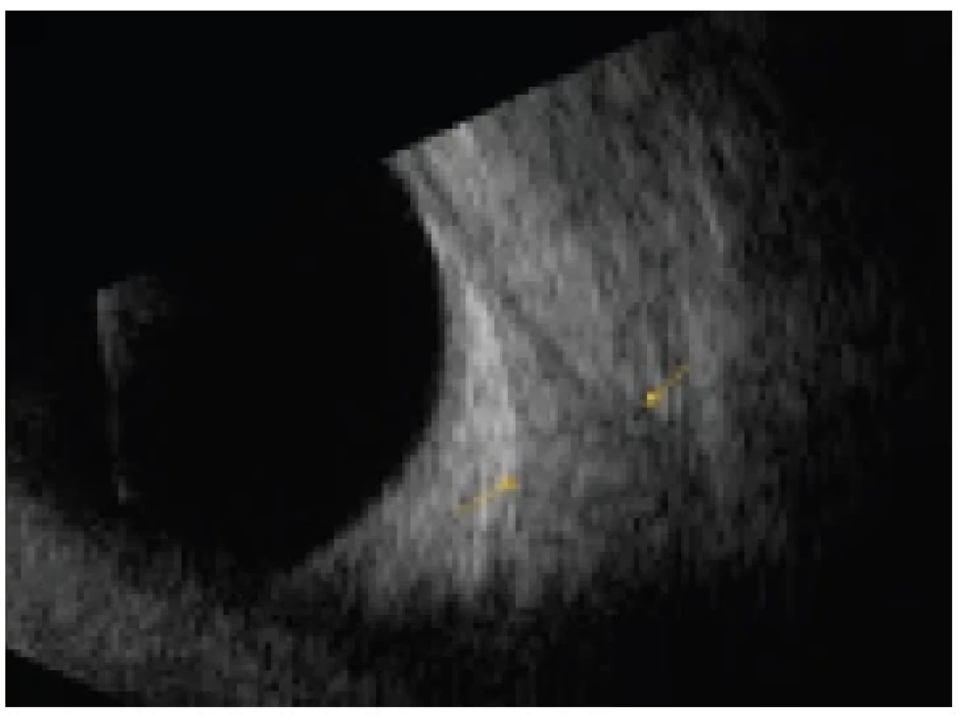 Enlargement of rectus muscle in patient with thyroid-
-associated orbitopathy in inactive phase of disease (muscle is
fibrotic) in view B, longitudinal view